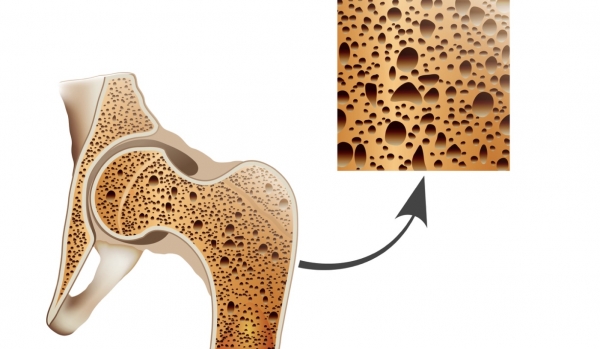 골다공증 뼈의 단면(사진:서울대학교병원)