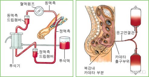신대체요법인 혈액투석(왼쪽)과 복막투석(오른쪽) 설명도(출처=삼성서울병원)