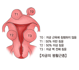 자궁근종(사진 출처: 서울아산병원)