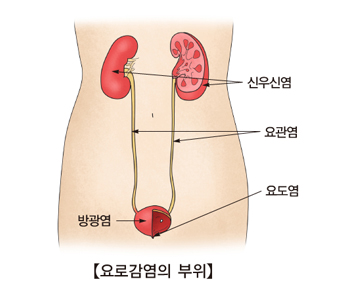 요로감염(사진출처:서울아산병원)